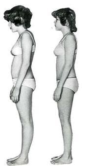 Side-by-side images of a woman in underwear displaying posture differences: slouched posture on the left and upright posture on the right.