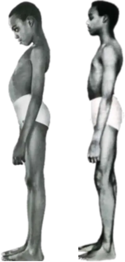 Side-by-side comparison of the same individual before and after treatment for Pellagra, showing differences in physical health and posture.